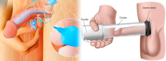 陰莖注射、真空壓力裝置和陰莖植入物