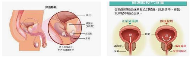 攝護腺癌的治療